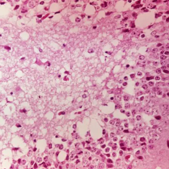 Venezuelan Equine Encephalitis